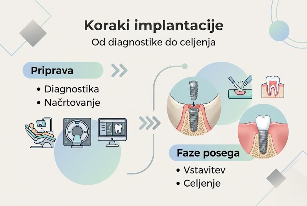 Pregled najpomembnejših korakov pri vstavitvi implantata na eni sliki
