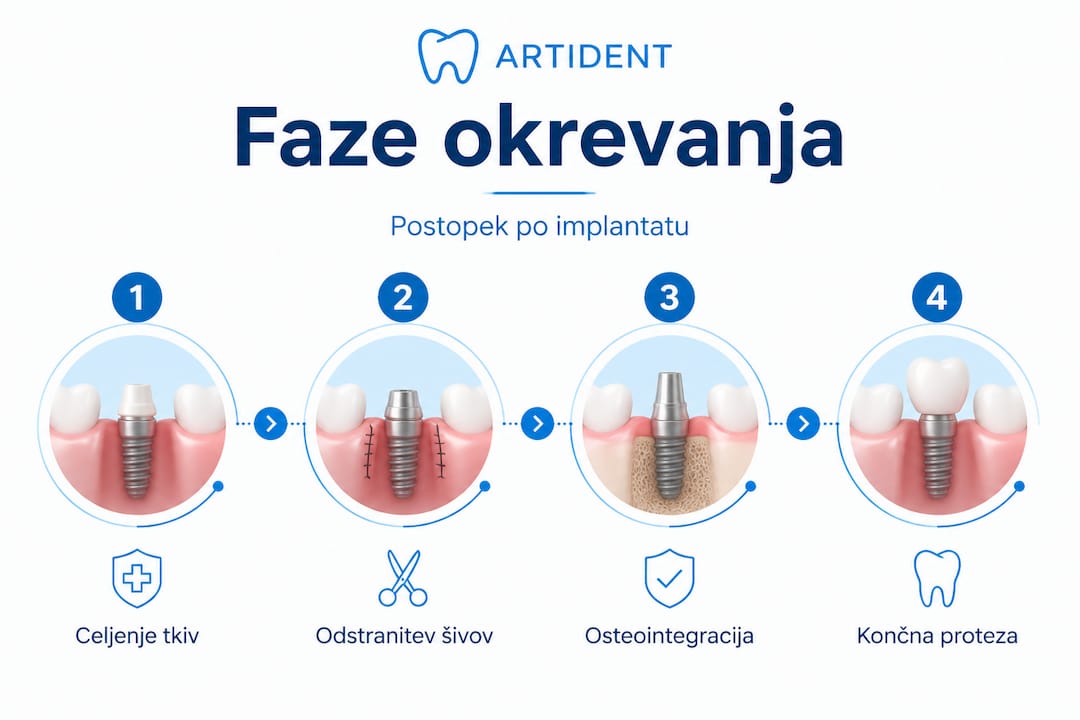 Pregled štirih ključnih faz okrevanja po vstavitvi zobnega vsadka v slikah