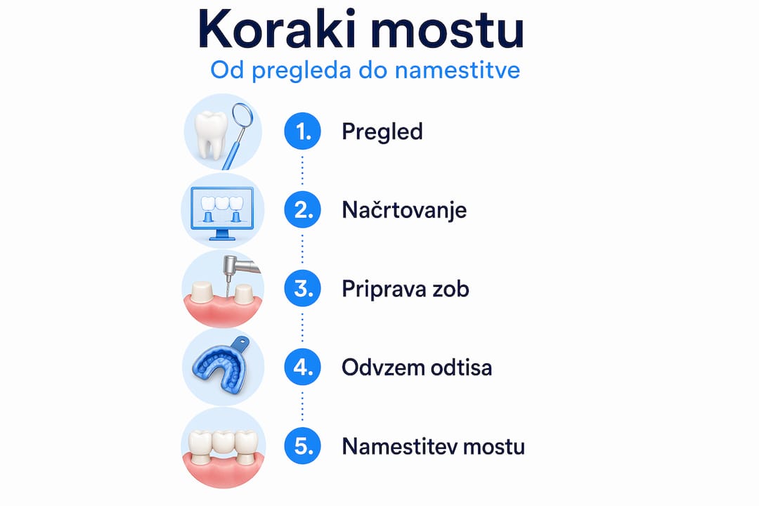 Infografika, ki prikazuje posamezne korake pri vstavitvi zobnega mostička