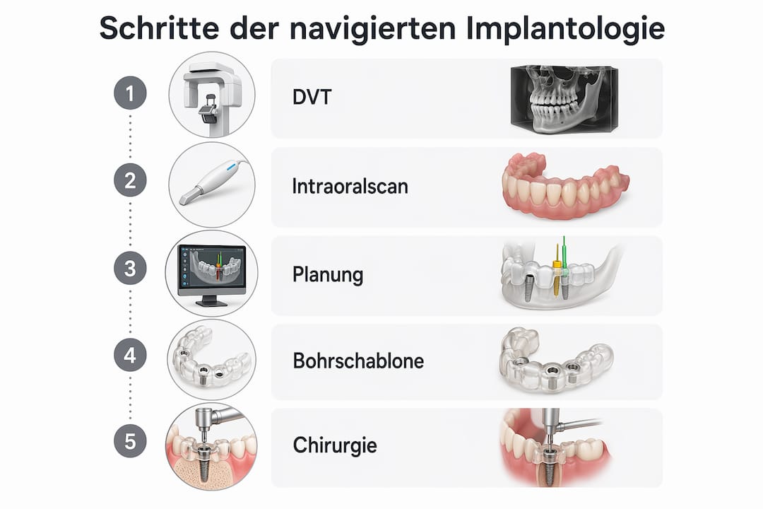 Eine anschauliche Infografik veranschaulicht die einzelnen Schritte der navigierten Implantologie.