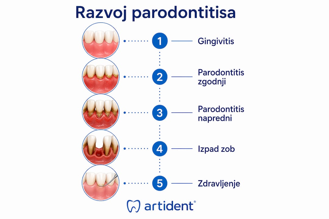 Grafični prikaz, ki ponazarja, kako se parodontalna bolezen postopoma razvija in napreduje skozi različne faze.