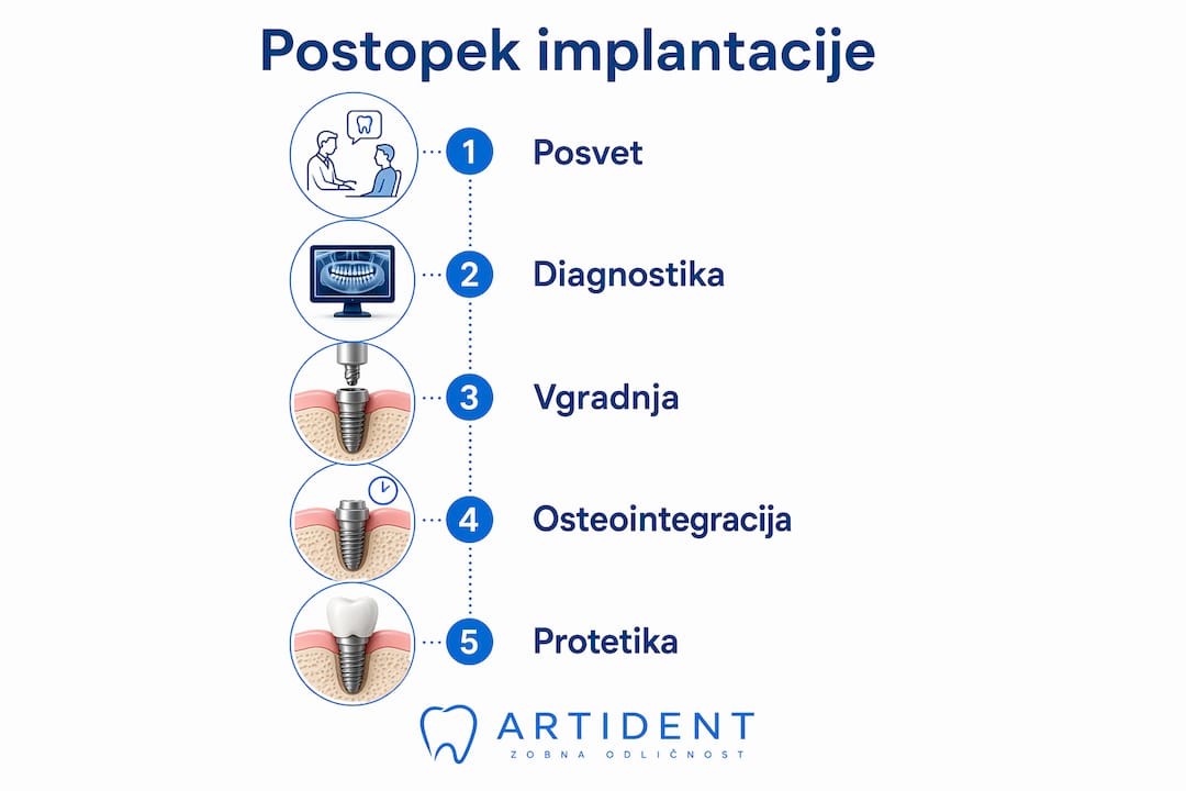 Nazoren prikaz poteka vstavitve zobnih implantatov