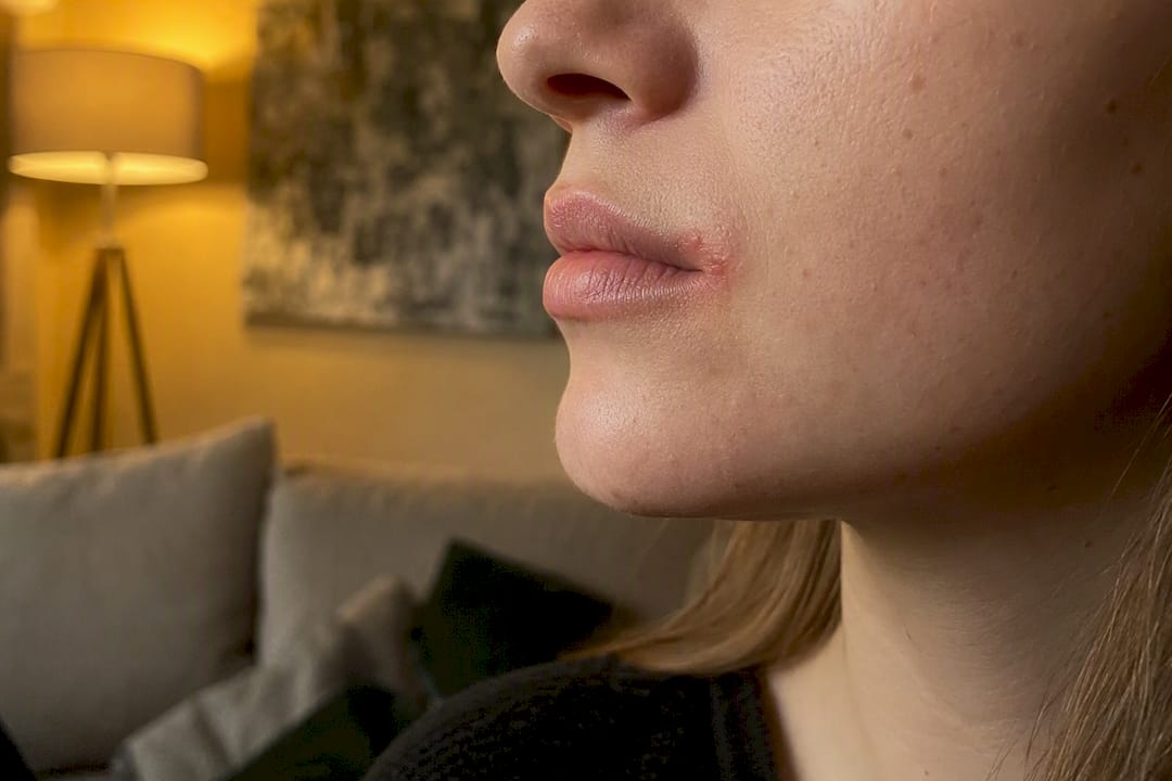 Swollen lip corner indicating allergy