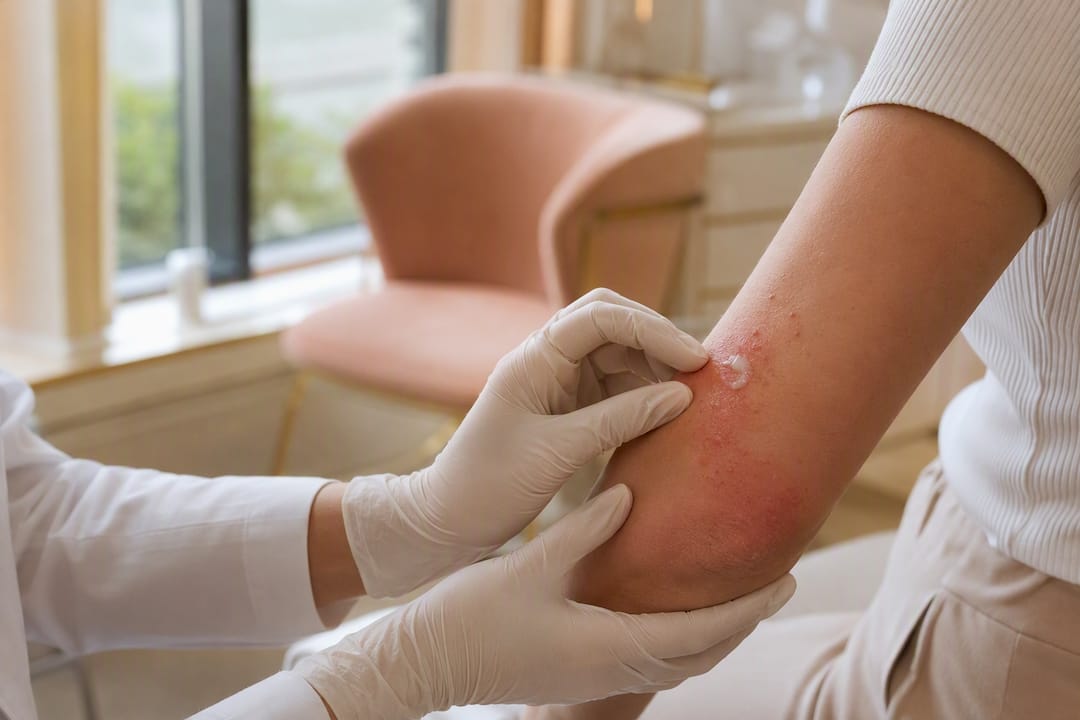 Main gantée examinant une peau irritée