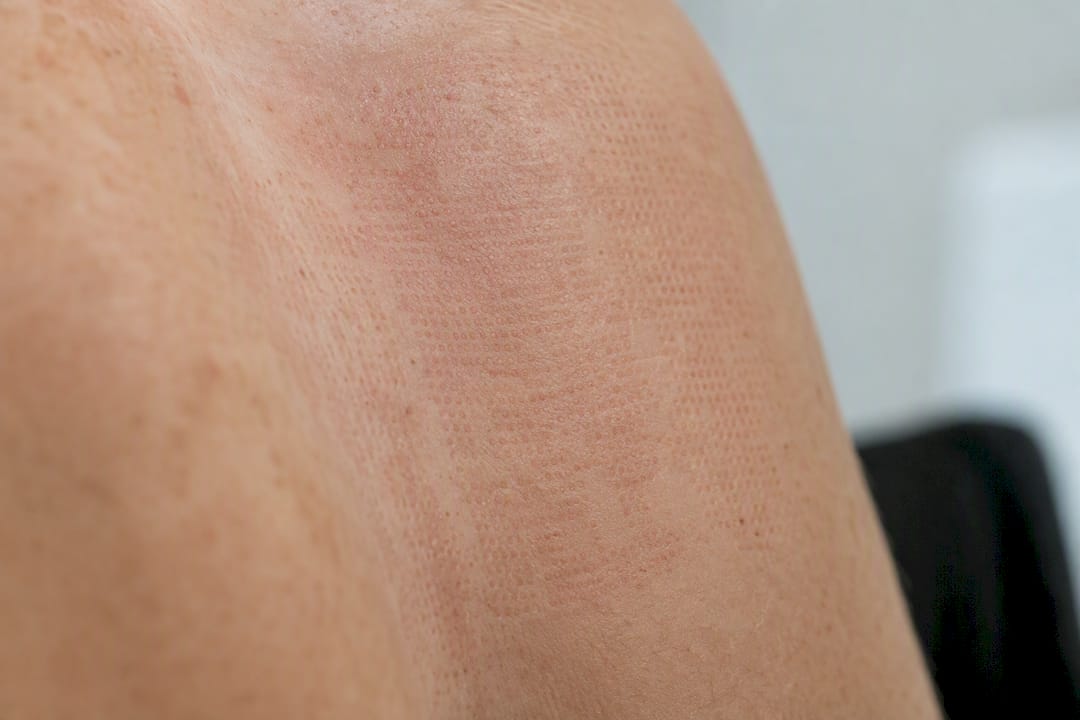 Aspecto de la piel con microcolumnas tras un tratamiento con láser fraccionado