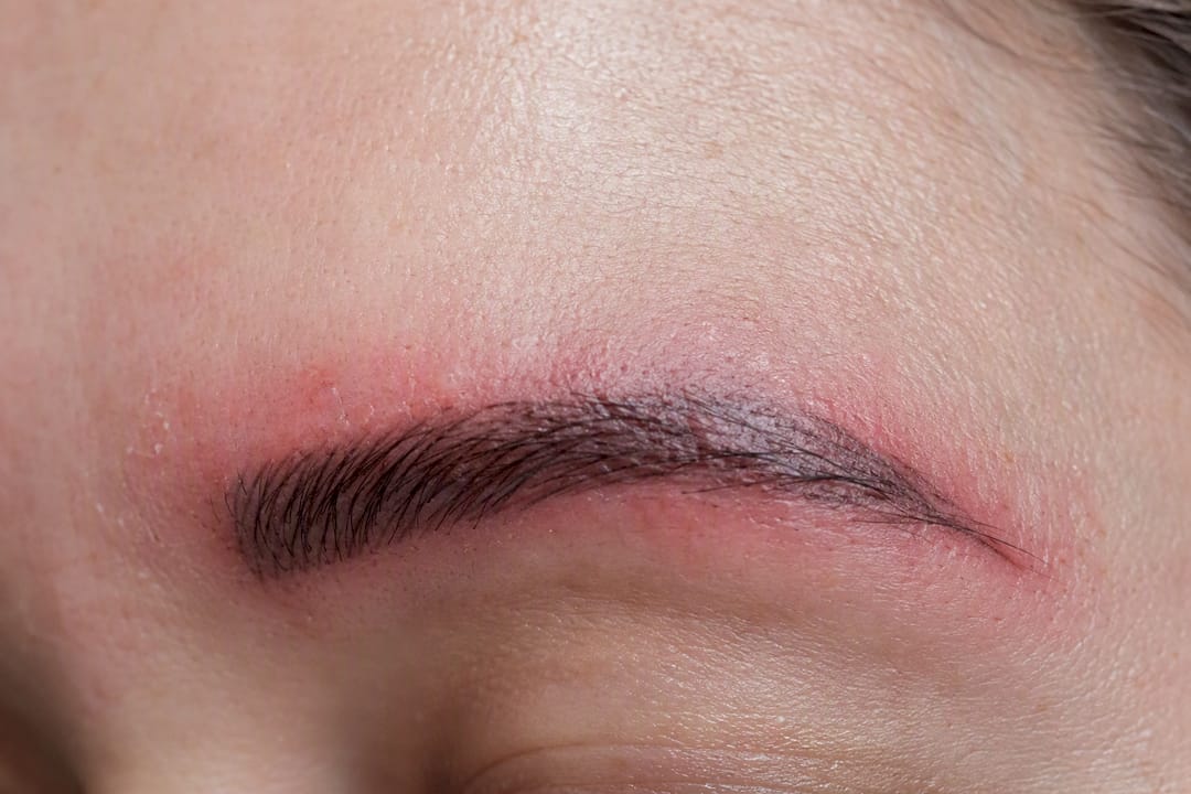Piel roja e irritada en la ceja después del microblading