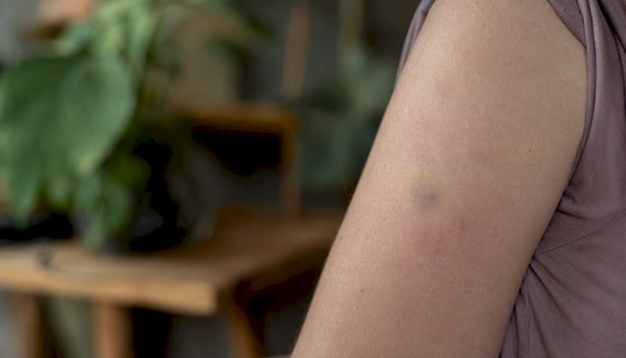 Fading bruise after acupuncture treatment