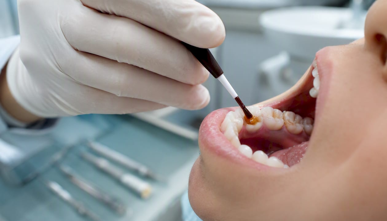Applying silver diamine fluoride to cavity