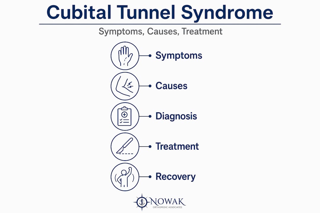 Infographic summarizing cubital tunnel syndrome stages