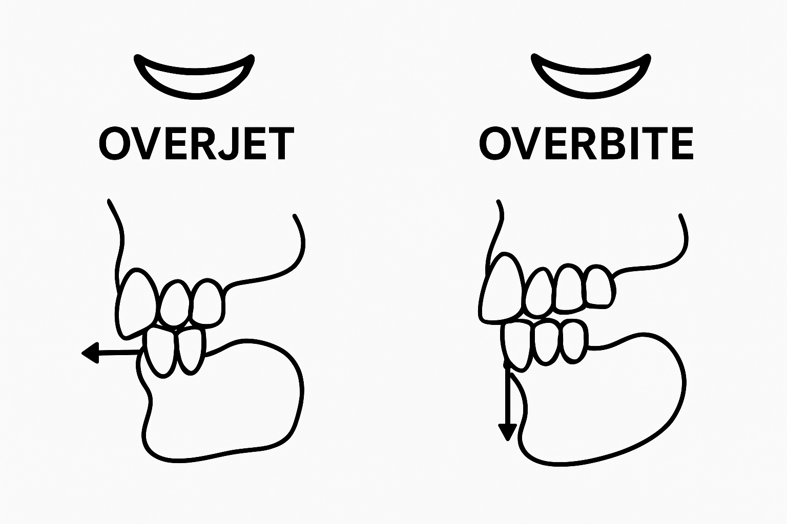 Side-by-side dental diagram comparison of overjet and overbite