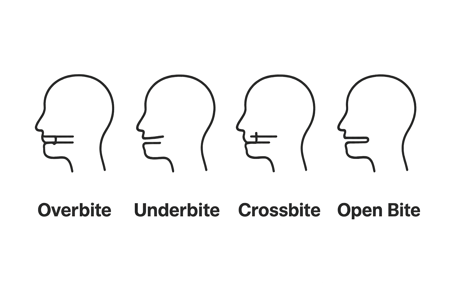 Infographic comparing overbite, underbite, crossbite, open bite jaw alignment