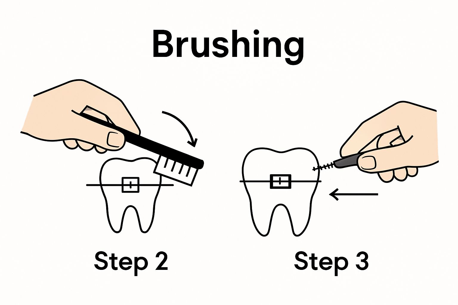 Visual guide showing two steps: brushing at a 45-degree angle and using an interdental brush for braces cleaning.
