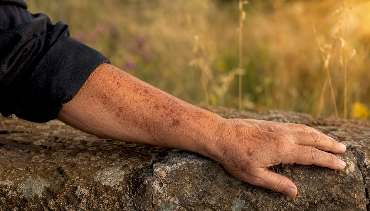 Close-up of hand with sunspots on skin