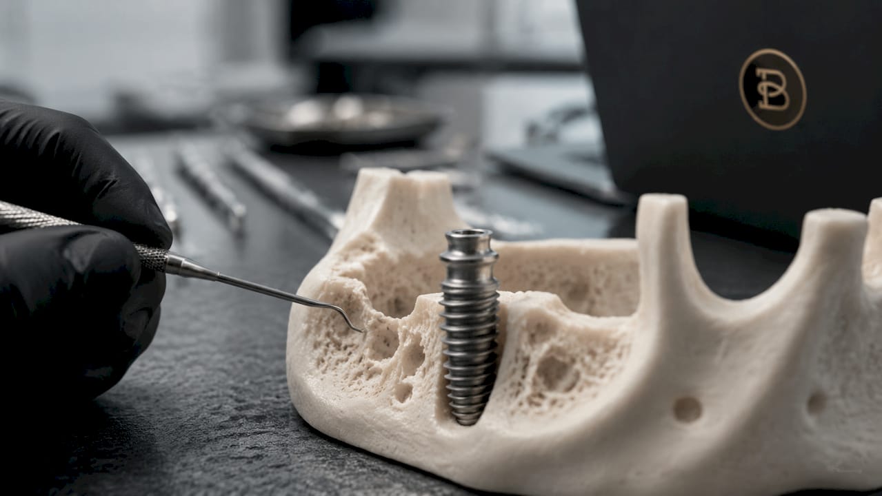 Close-up of titanium dental implant in jawbone model
