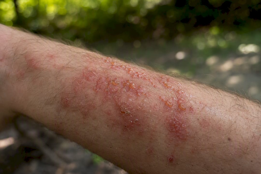 Poison ivy rash on human forearm