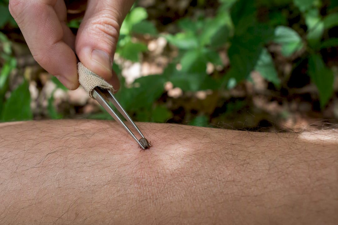 Gauze wrapped tweezers gripping tick