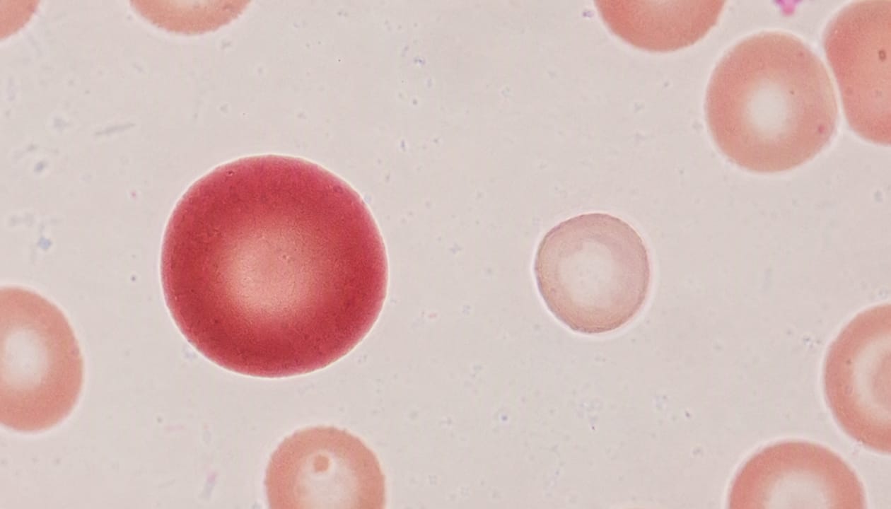 Imagine la microscop a globulelor roșii sănătoase comparativ cu cele afectate de lipsa de fier