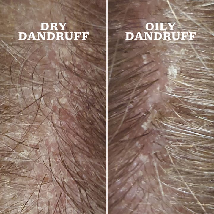 Woman inspecting scalp for dandruff symptoms