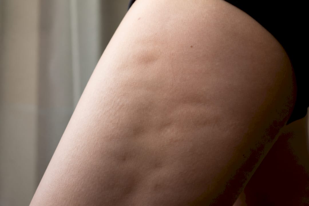 Zoom sur la peau présentant un aspect capitonné caractéristique de la cellulite