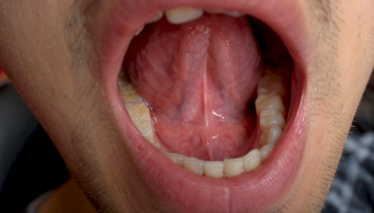 Close-up inside mouth showing sublingual mucosa anatomy