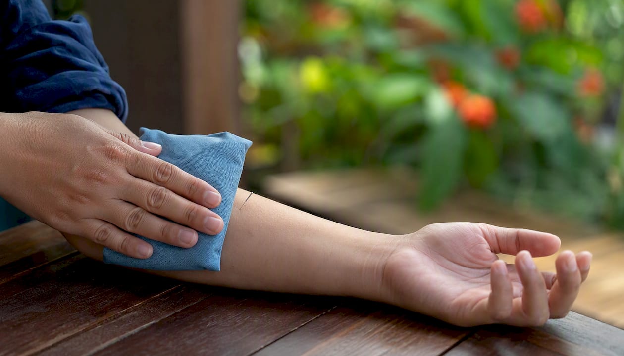 Cold pack applied to acupuncture treatment site