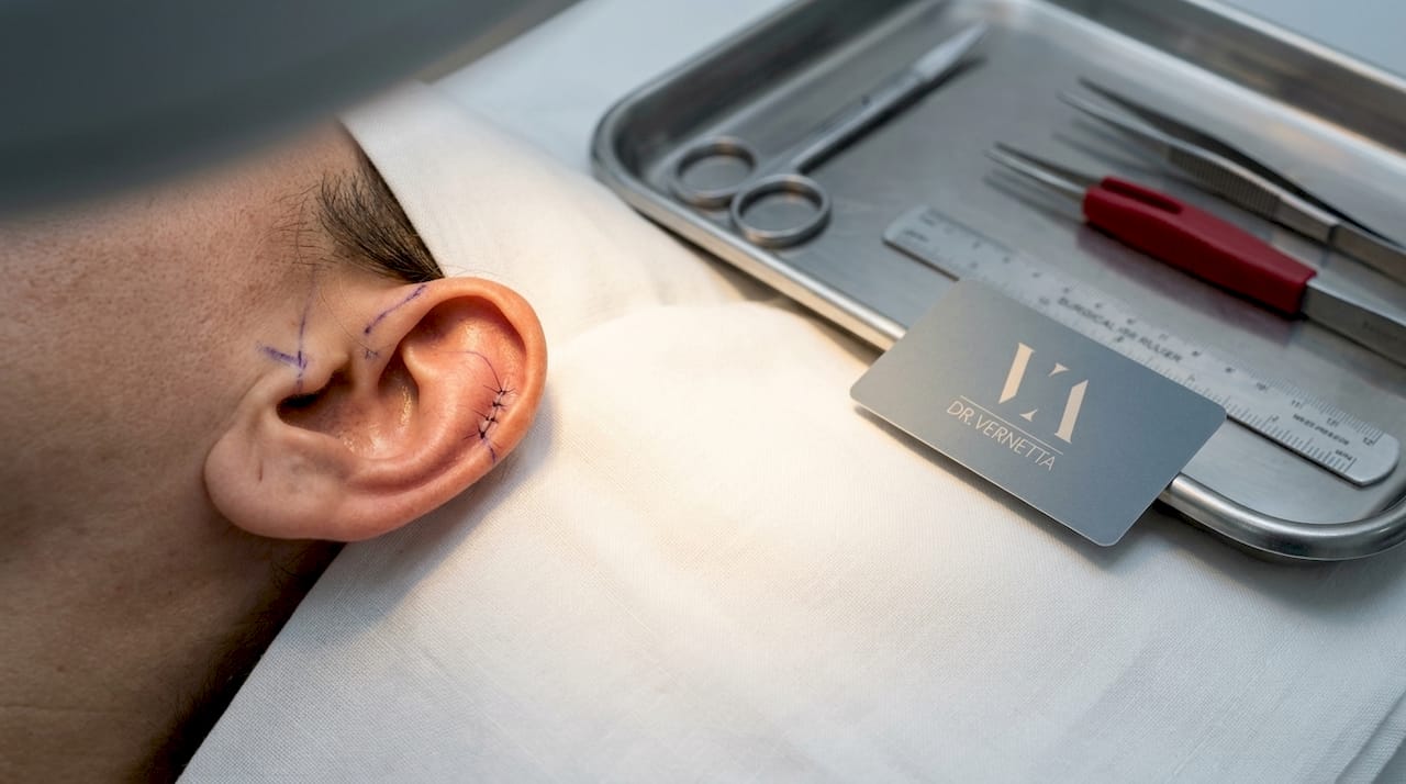 Imagen en primer plano de una oreja con las marcas preparatorias para una cirugía de otoplastia.