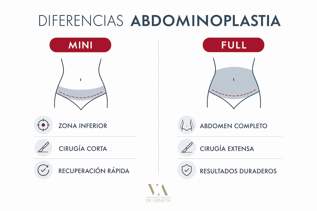 Infografía: diferencias clave entre la miniabdominoplastia y la abdominoplastia completa