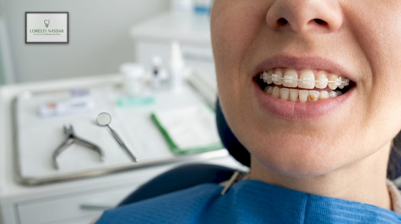 Exemple de tratamente eficiente pentru alinierea dinților în 2026 1 Pacient adult care poartă aparat dentar ceramic