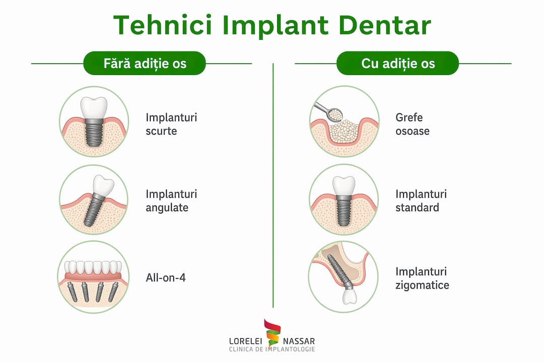 Implant dentar fără adiție de os: ghid complet 2026 2 Infografic: diferențele dintre principalele metode de implant dentar