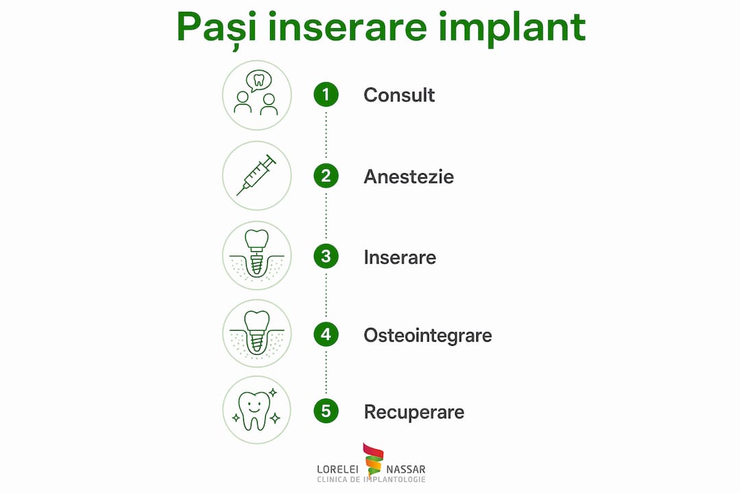 Infografic: etapele montării unui implant dentar, explicate pas cu pas