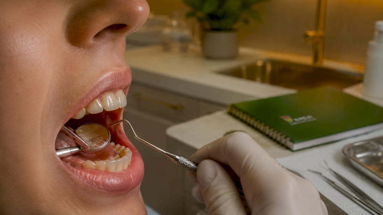 Placa dentară: ghid complet pentru sănătatea orală 1 Imagine detaliată a depunerii plăcii bacteriene pe suprafața unui dinte