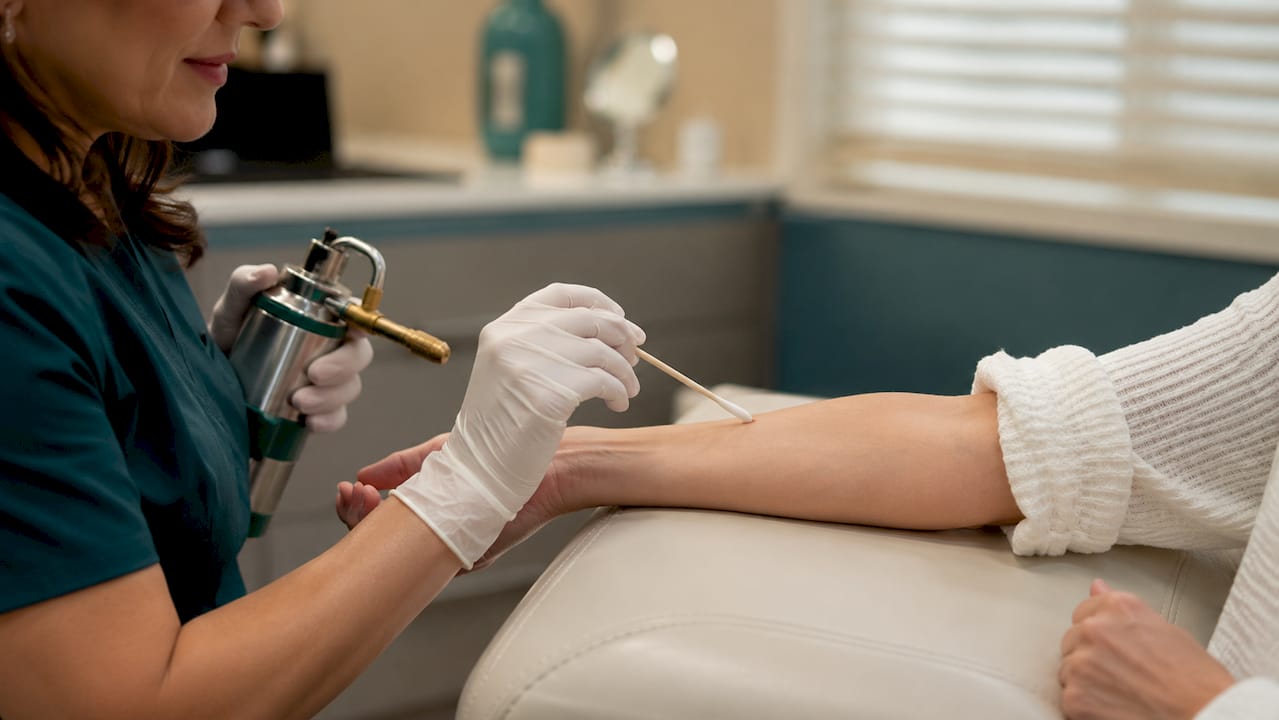 Dermatologist applying cryotherapy to sun spot on hand