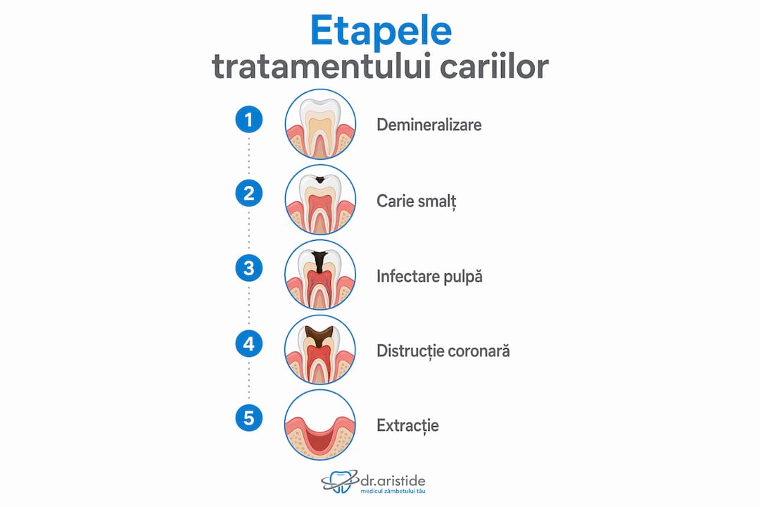 Infografic: pașii esențiali în tratarea cariilor dentare