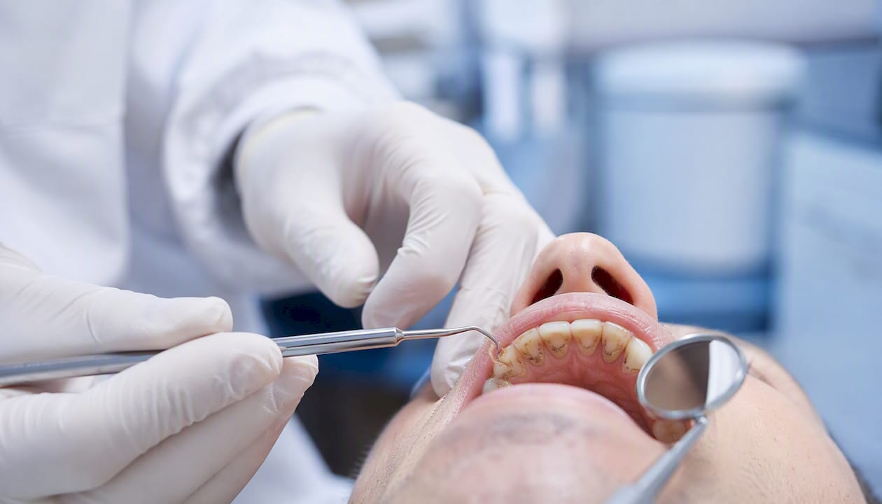 O sondă dentară folosită pentru a verifica depunerile de tartru de pe dinți