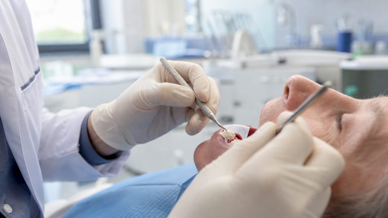 Detaliu asupra procedurii de conservare a alveolei dentare prin adăugarea de material osos