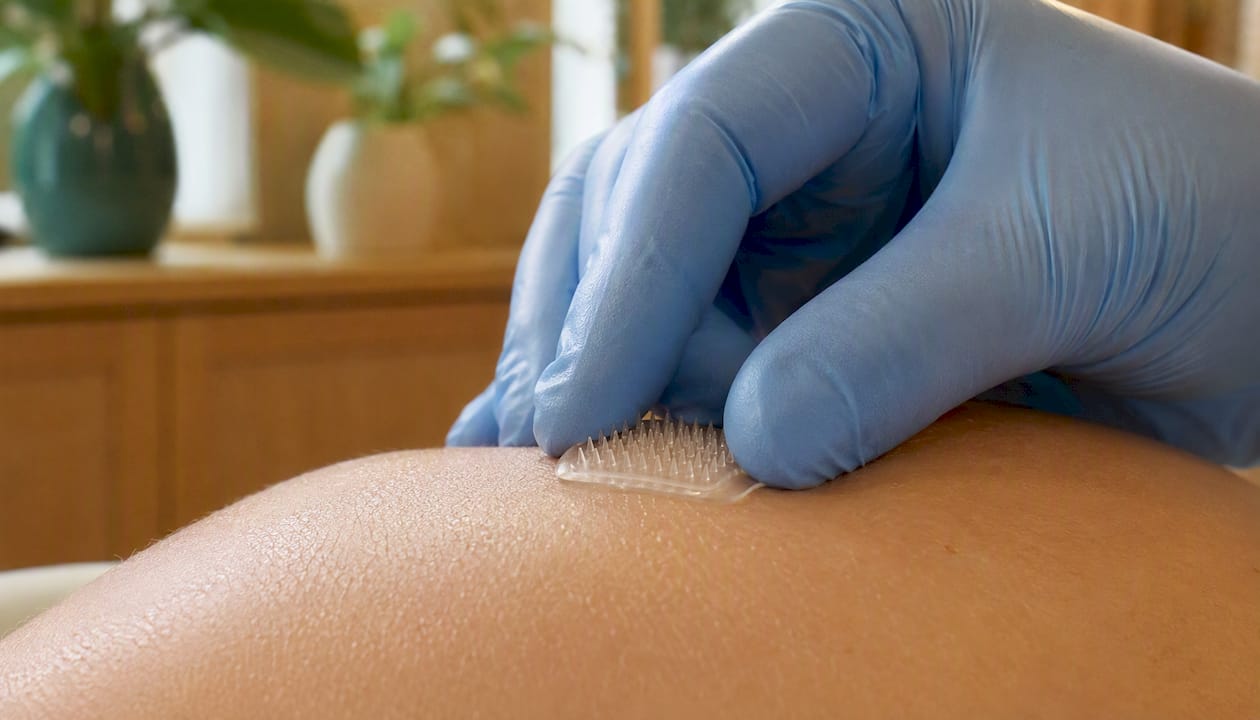 Microneedle patch applied on skin close-up