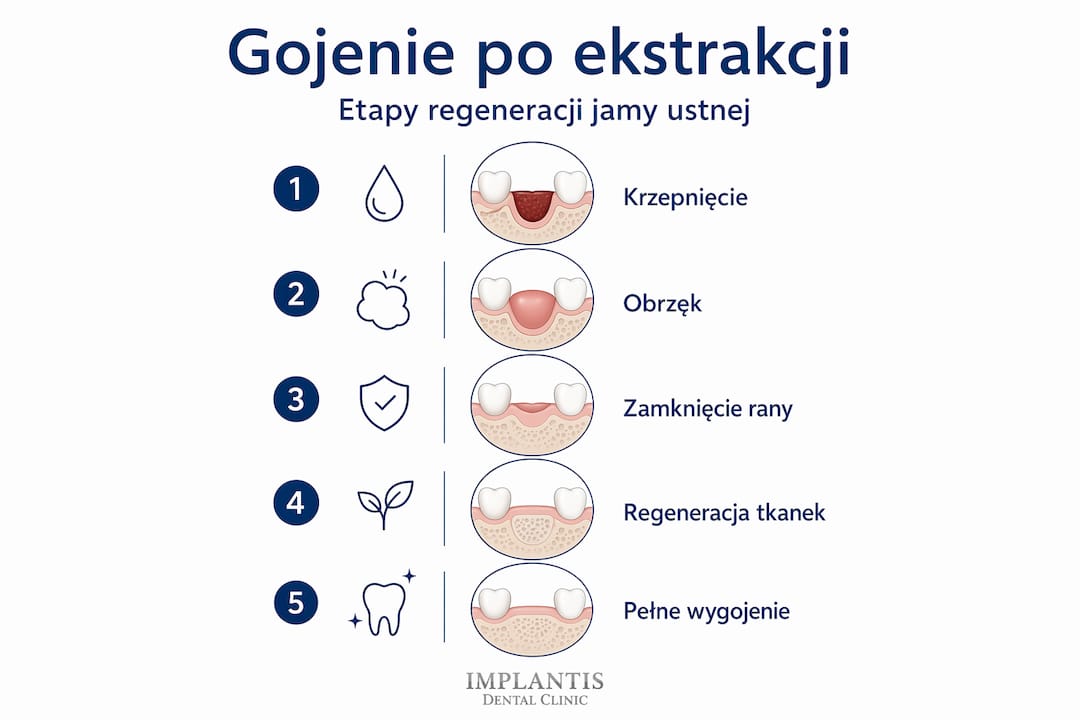 Infografika: jak przebiega gojenie po usunięciu zęba – krok po kroku