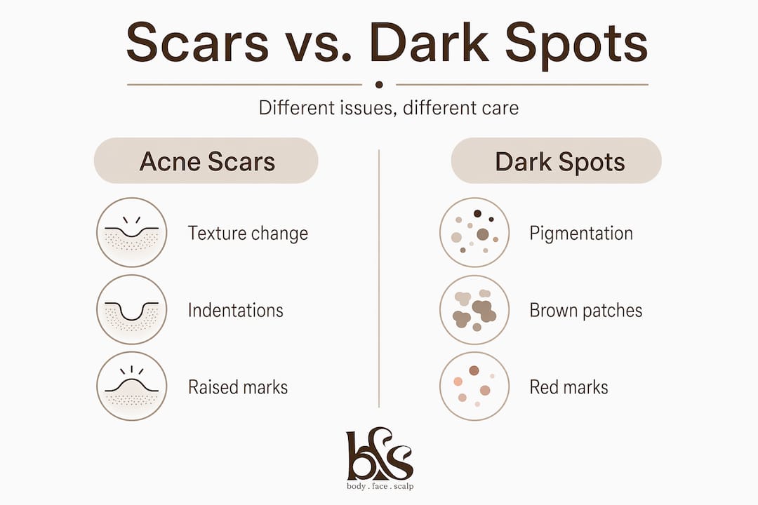 Infographic comparing acne scars and dark spots