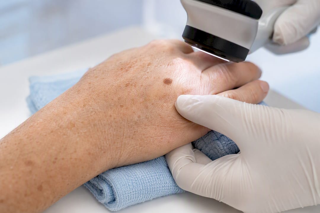 Dermatologist checking a changing hand spot