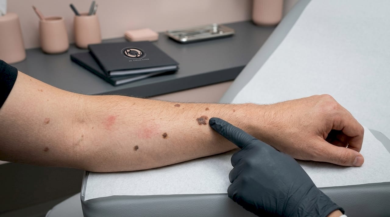 Close-up of forearm with multiple skin lesions
