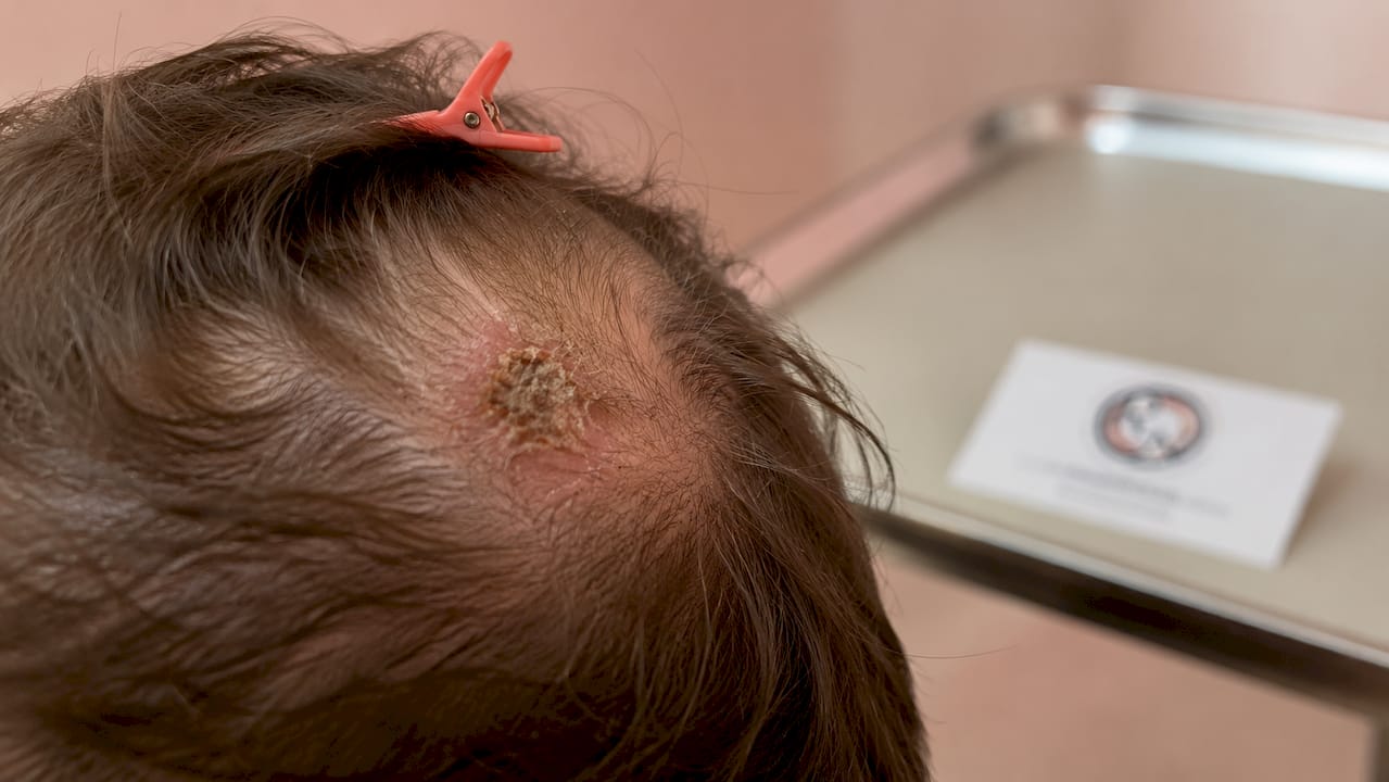 Close-up of crusted lesion on scalp with thinning hair