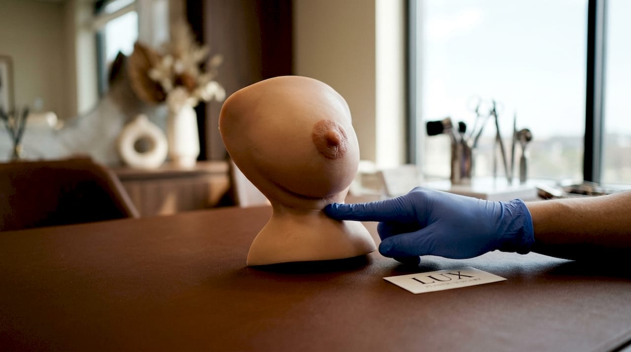 3D breast model showing tuberous breast features