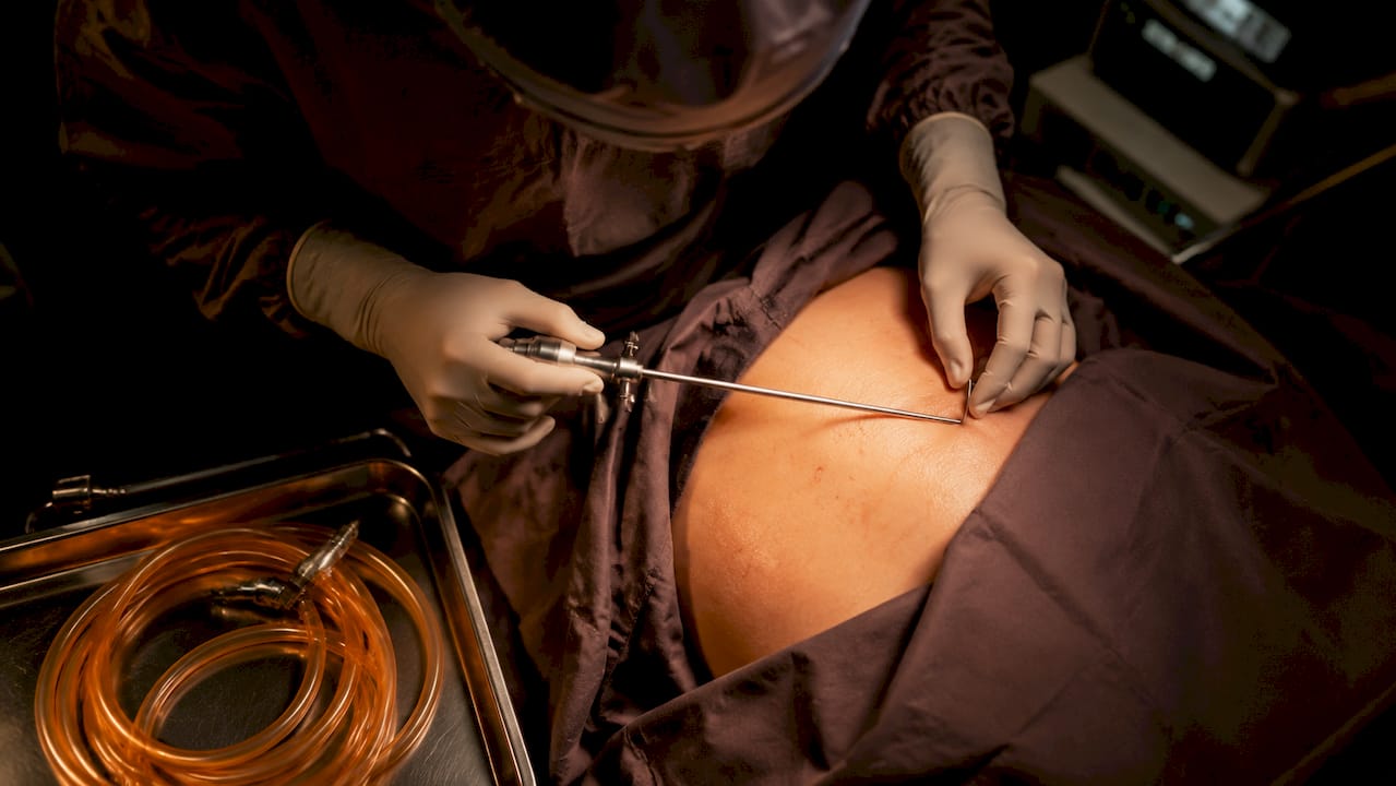 Surgeon's hands performing liposuction on lipoma