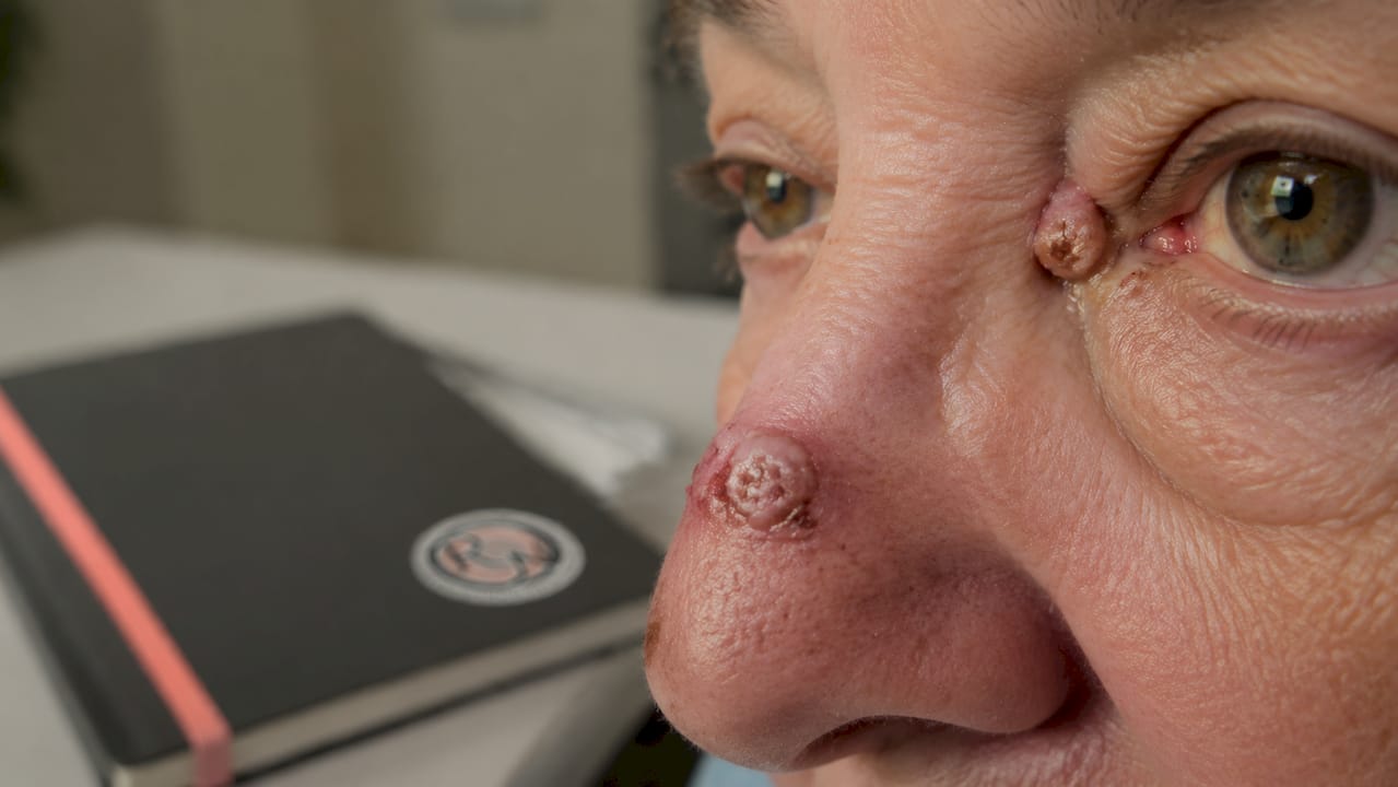Close-up of facial skin cancer lesions on nose and eyelid
