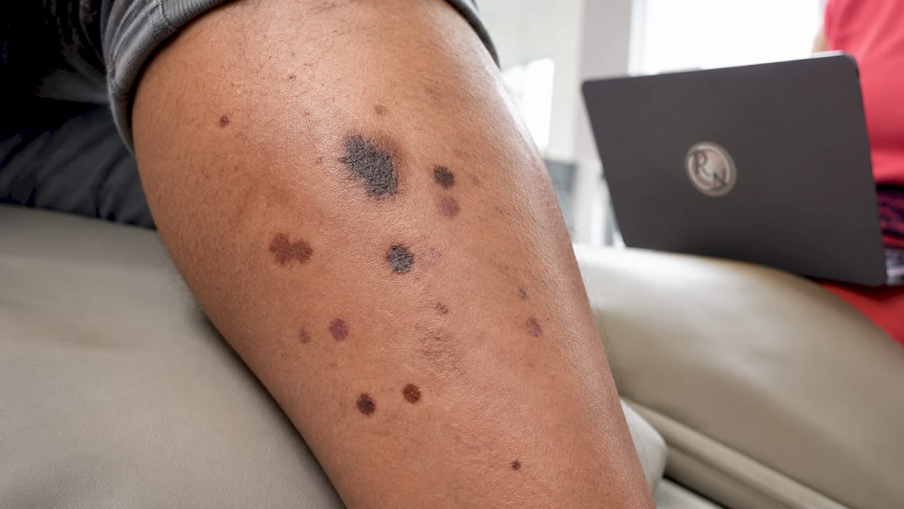 Close-up of arm with suspicious melanoma spots visible
