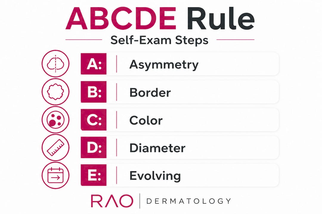 Infographic showing ABCDE rule for skin checks