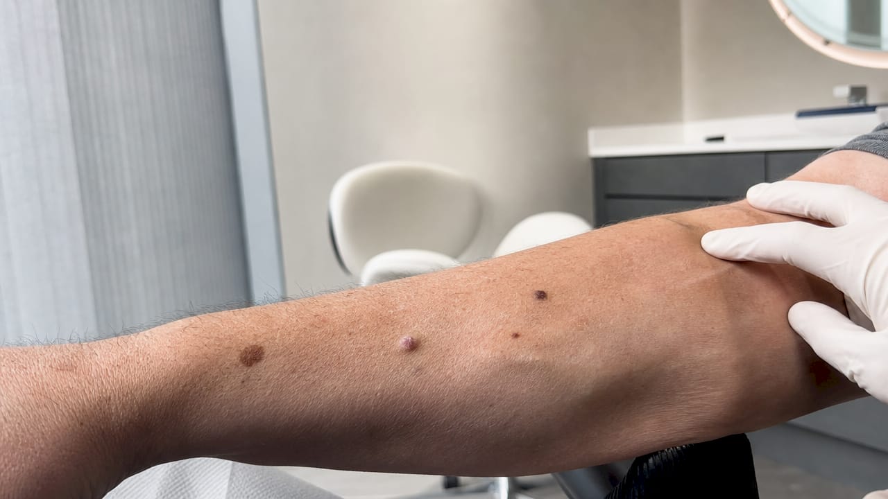 Close-up of different skin lesion types on skin