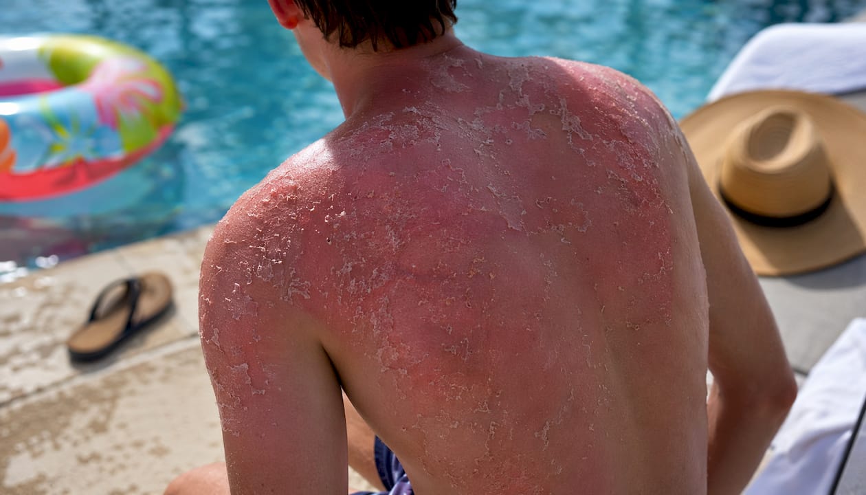 Teenager's sunburned back at the beach