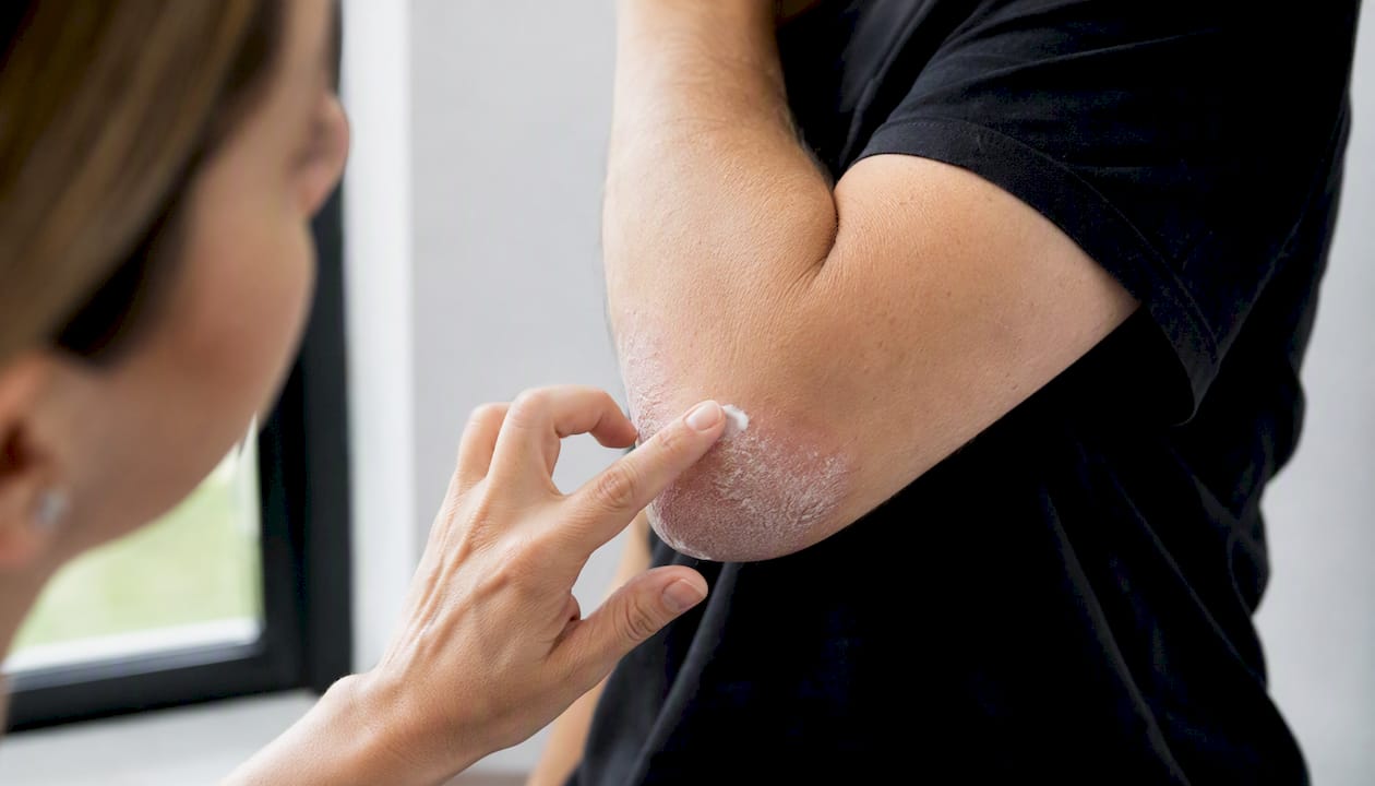 Fingertip with salicylic acid cream near psoriasis plaque