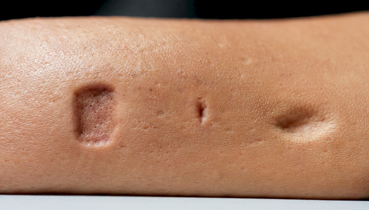 Close-up textures of various acne scar types